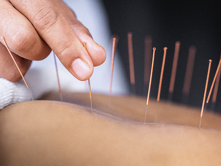 body acupuncture