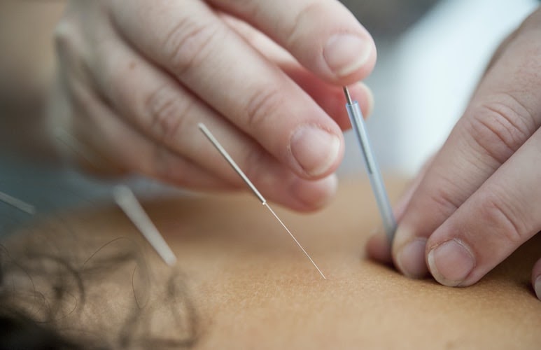 acupuncture and chiropractic